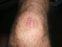 I got hit with a softball on my knee, and it looked like this, soon afterward. Yes, it did hurt.